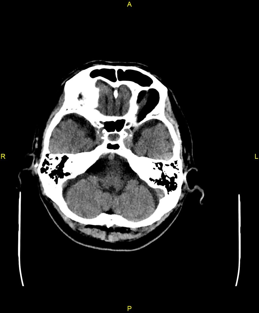 Bilateral isodense subdural hematomas (Radiopaedia 88621-105325 Axial non-contrast 22).jpg