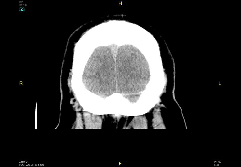 File:Bilateral medial medullary infarction (Radiopaedia 42220-45295 Coronal non-contrast 53).jpg