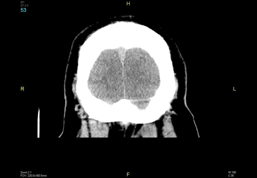 Bilateral medial medullary infarction (Radiopaedia 42220-45295 Coronal non-contrast 53).jpg