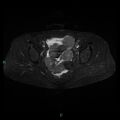 Bilateral ovarian fibroma (Radiopaedia 44568-48293 Axial STIR 16).jpg
