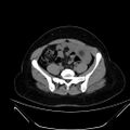 Bilateral ovarian mature cystic teratomas (Radiopaedia 79373-92457 Axial non-contrast 43).jpg