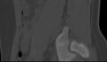 Bilateral pars defect (Radiopaedia 26691-26846 Sagittal bone window 52).jpg