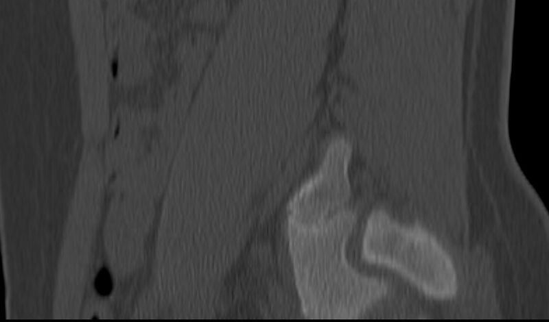 File:Bilateral pars defect (Radiopaedia 26691-26846 Sagittal bone window 52).jpg