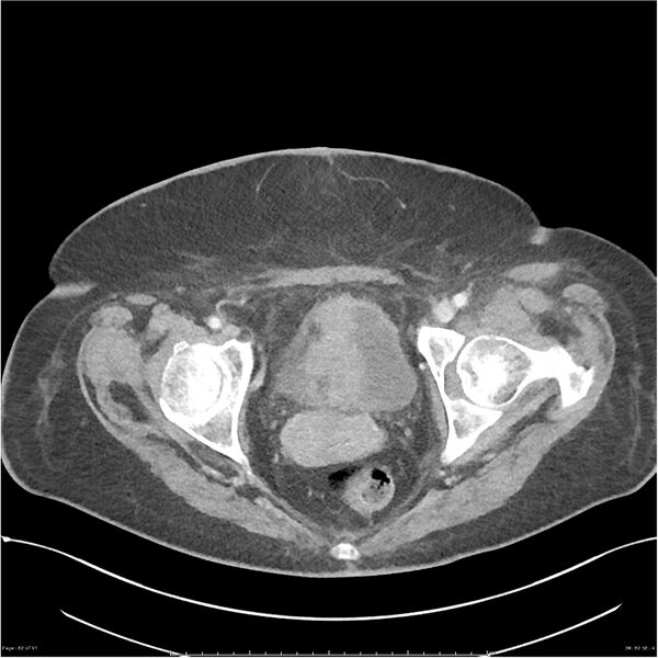 File:Bilateral psoas hematomas (Radiopaedia 24057-24279 A 82).jpg