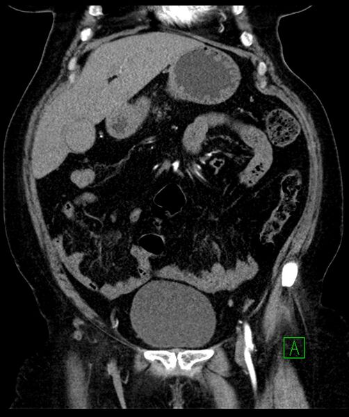 File:Bilateral sporadic synchronous clear cell renal cell carcinoma (Radiopaedia 85035-100575 D 39).jpg