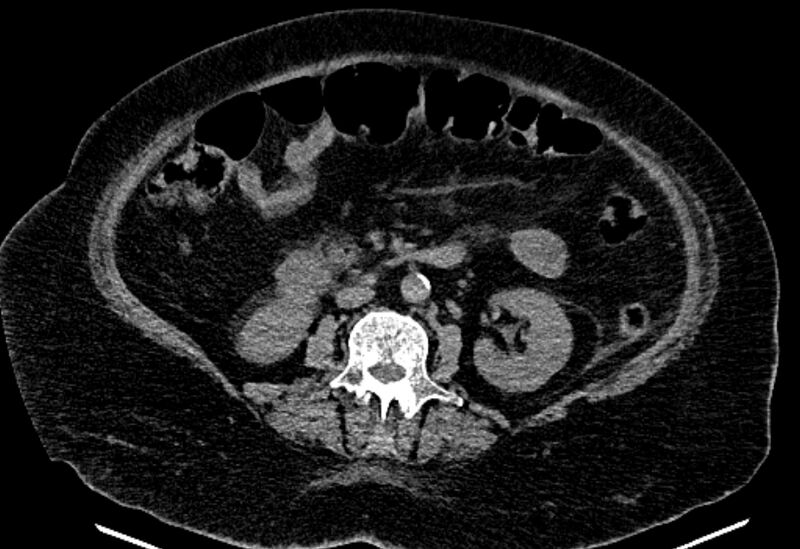 File:Biliary pancreatitis (Radiopaedia 72289-82823 Axial non-contrast 135).jpg