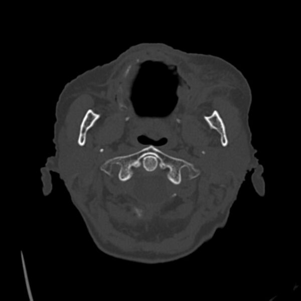 File:Biparietal osteodystrophy (Radiopaedia 46109-50463 bone window 5).jpg