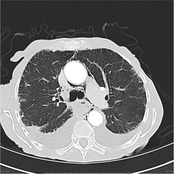 File:Boerhaave syndrome (Radiopaedia 26240-26362 Axial lung window 18).jpg