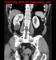 Bosniak renal cyst - type II (Radiopaedia 23404-23468 E 32).jpg