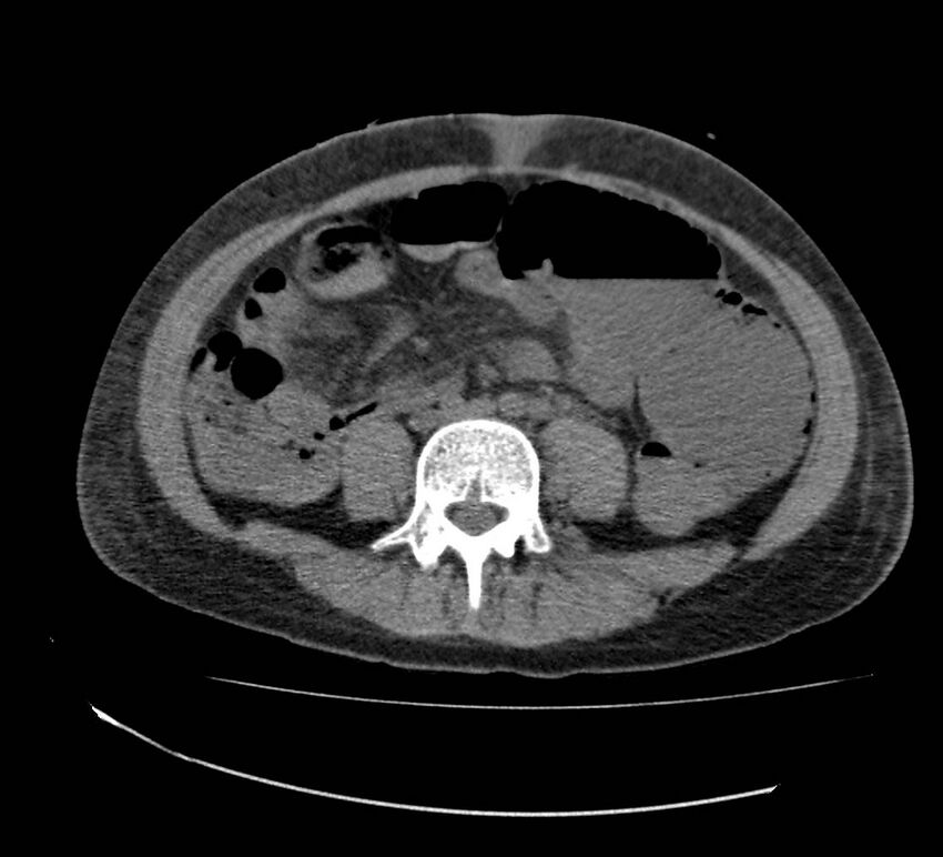 Bowel lymphoma complicated by bleeding after therapy (Radiopaedia 55601-62110 Axial non-contrast 50).jpg