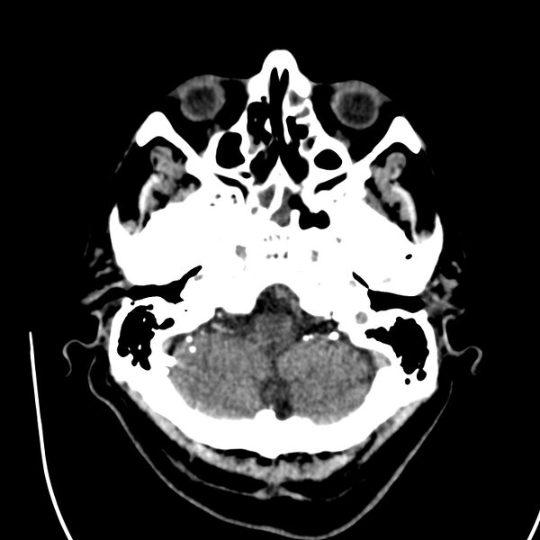 File:Brain Pantopaque remnants (Radiopaedia 78403-91048 Axial non-contrast 25).jpg