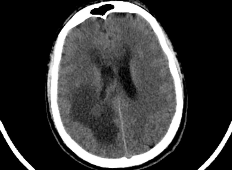 File:Brain abscess complicated by intraventricular rupture and ventriculitis (Radiopaedia 82434-96575 Axial non-contrast 71).jpg