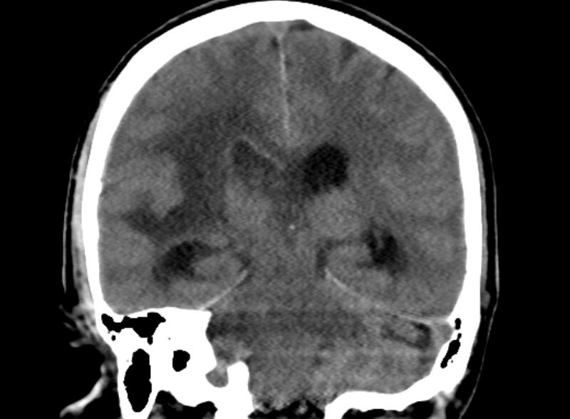 File:Brain abscess complicated by intraventricular rupture and ventriculitis (Radiopaedia 82434-96575 Coronal non-contrast 16).jpg