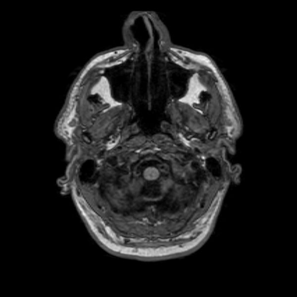 File:Brain abscess complicated by intraventricular rupture and ventriculitis (Radiopaedia 82434-96577 Axial T1 1).jpg