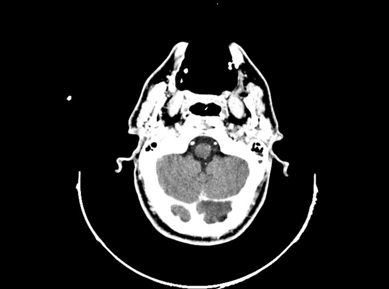 File:Brain injury by firearm projectile (Radiopaedia 82068-96088 B 68).jpg