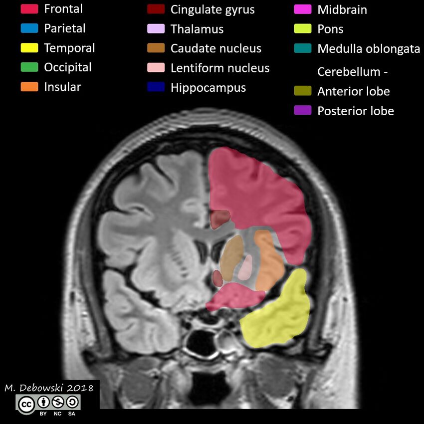 Brain lobes - annotated MRI (Radiopaedia 61691-69700 Coronal 24).JPG