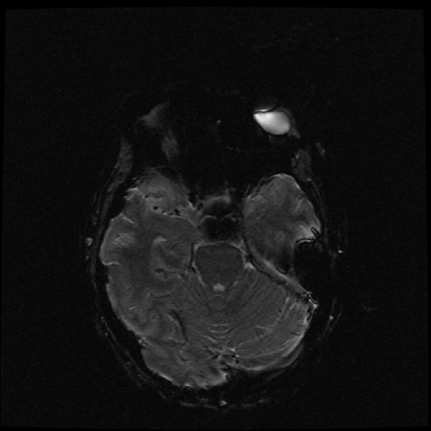 Brain metastases (renal cell carcinoma) (Radiopaedia 42571-45704 Axial SWI 43).jpg