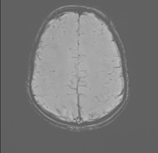 File:Brainstem glioma (Radiopaedia 70548-80674 Axial SWI 48).jpg