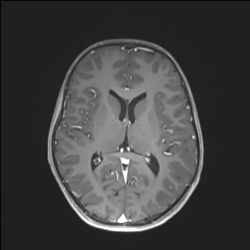 Brainstem glioma (Radiopaedia 70548-80674 Axial T1 C+ 89).jpg