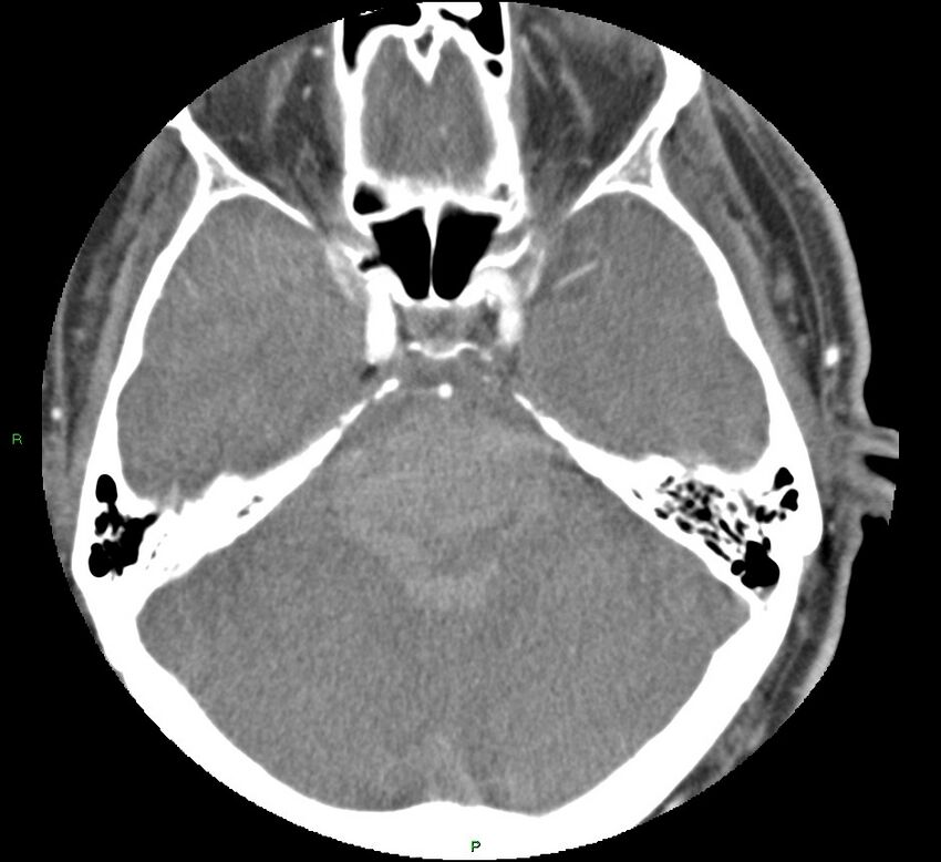 Brainstem hemorrhage (Radiopaedia 58794-66028 D 63).jpg