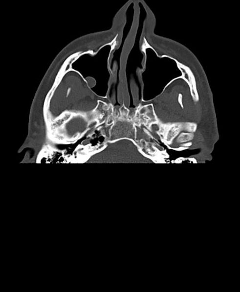 File:Branchial cleft cyst (Radiopaedia 31167-31875 Axial bone window 6).jpg