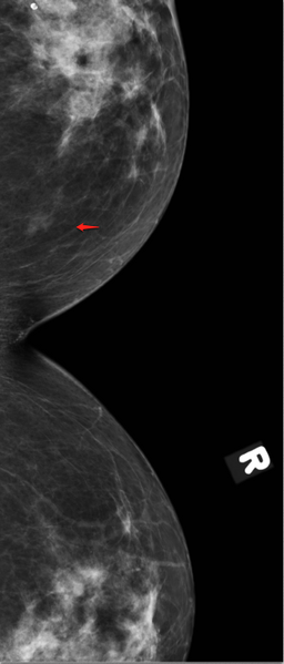 File:Breast asymmetry - interpretation pitfall (Radiopaedia 21654-21612 Valley 1).png