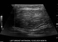 Breast lipoma (Radiopaedia 16321-16005 A 2).jpg