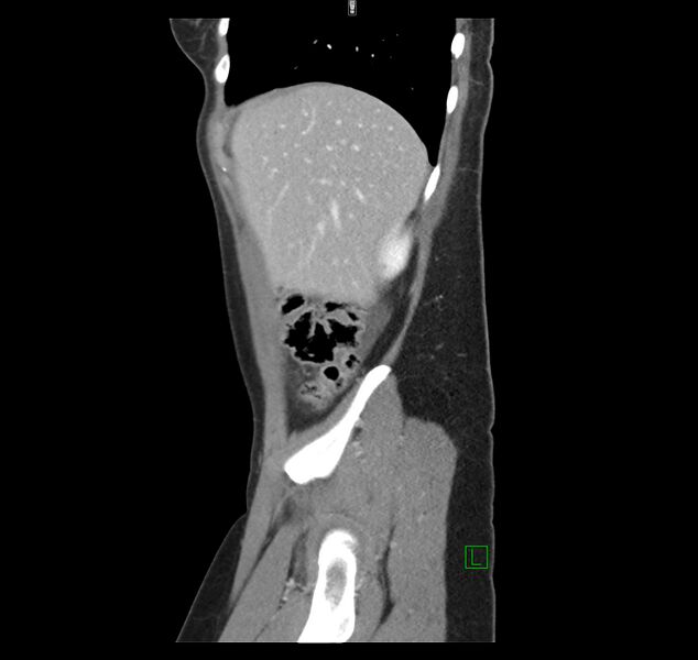 File:Broad ligament hernia (Radiopaedia 63260-71832 C 10).jpg