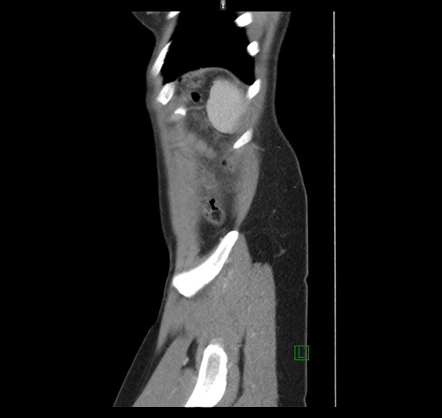 File:Broad ligament hernia (Radiopaedia 63260-71832 C 49).jpg