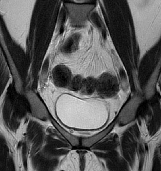 File:Broad ligament leiomyoma (Radiopaedia 81634-95516 Coronal T2 7).jpg