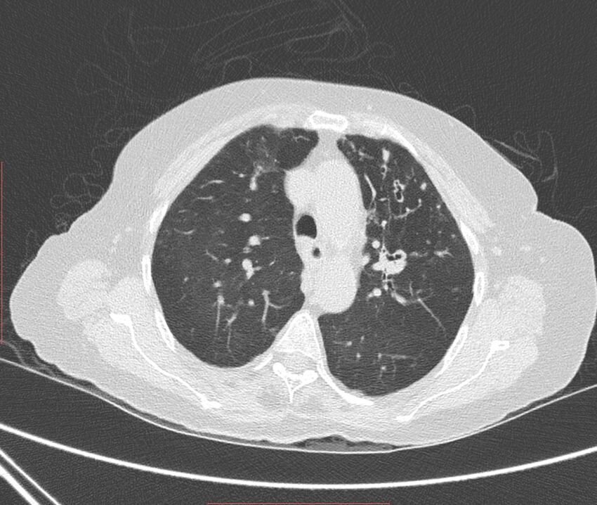 Bronchiectasis (Radiopaedia 72693-83293 Axial lung window 38).jpg
