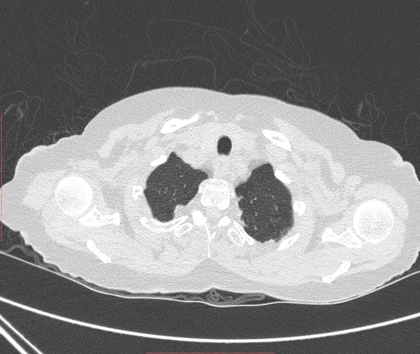 Bronchiectasis (Radiopaedia 72693-83293 Axial lung window 6).jpg