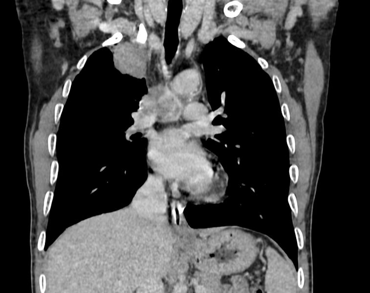 File:Bronchogenic carcinoma with superior vena cava syndrome (Radiopaedia 36497-38054 Coronal C+ delayed 37).jpg