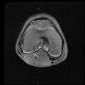 Bucket handle tear - lateral meniscus (Radiopaedia 72124-82634 Axial PD fat sat 8).jpg