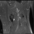 Bucket handle tear - lateral meniscus (Radiopaedia 7246-8187 Coronal T2 fat sat 4).jpg