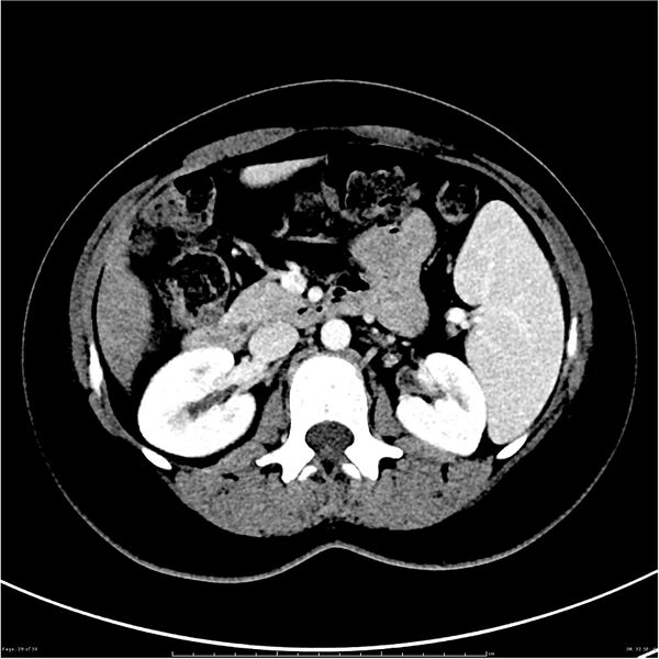 File:Budd-Chiari syndrome (Radiopaedia 27929-28177 Axial liver window 28).JPG