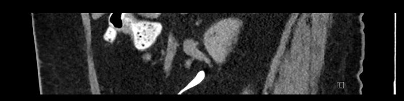 File:Buried bumper syndrome - gastrostomy tube (Radiopaedia 63843-72575 Sagittal Inject 81).jpg