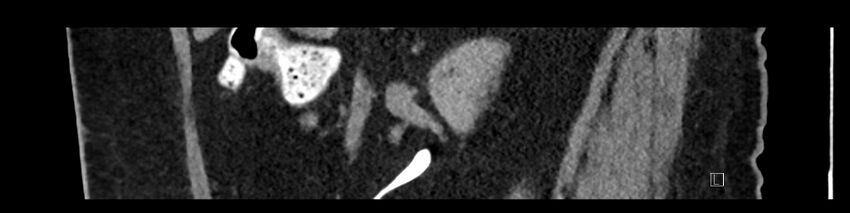 Buried bumper syndrome - gastrostomy tube (Radiopaedia 63843-72575 Sagittal Inject 81).jpg