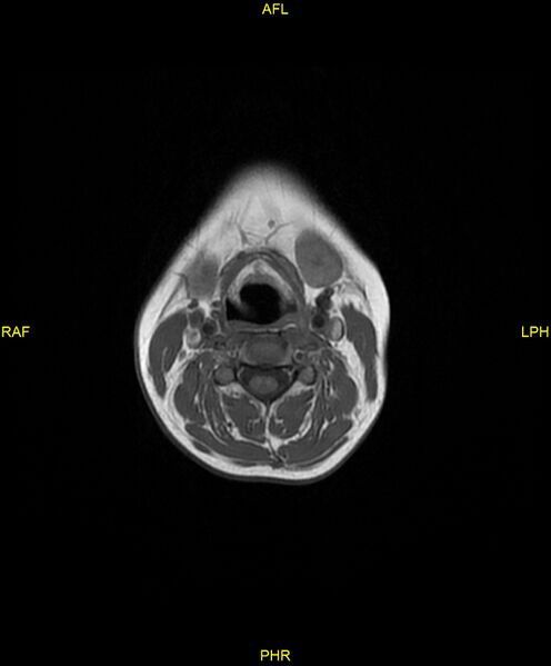 File:C5 nerve sheath tumor (Radiopaedia 85777-101596 Axial T1 11).jpg