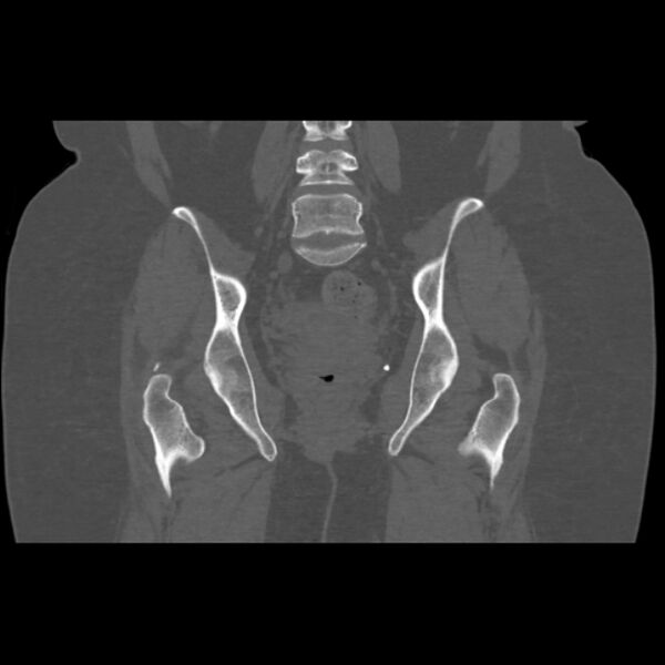 File:Calcific tendinitis of the gluteus medius muscle (Radiopaedia 66998-76318 Coronal bone window 35).jpg