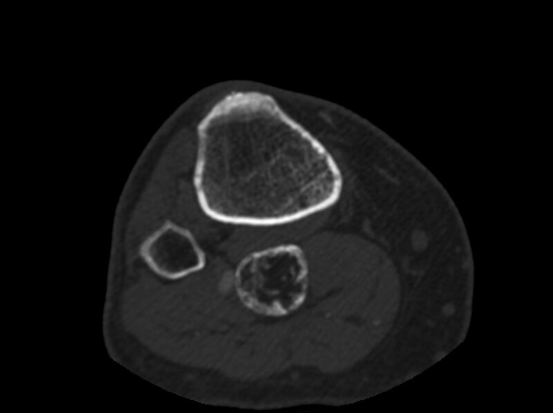 File:Calcified hematoma - popliteal fossa (Radiopaedia 63938-72763 C 84).jpg