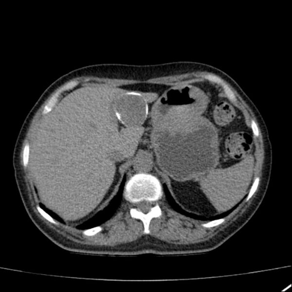 File:Calcified hepatic hydatid cyst (Radiopaedia 26872-27046 Axial non-contrast 21).jpg