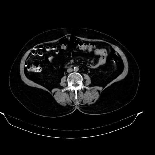 File:Calcified hydatid cyst (Radiopaedia 62000-70085 Axial non-contrast 60).jpg