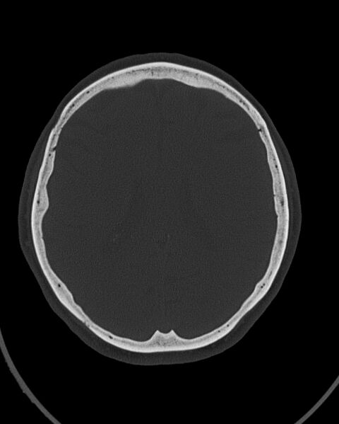 File:Calcified meningioma (Radiopaedia 74361-85243 Axial bone window 20).jpg