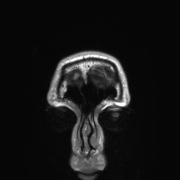 File:Callosal dysgenesis with interhemispheric cyst (Radiopaedia 53355-59335 Coronal T1 185).jpg
