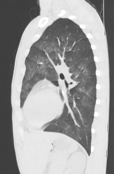 File:Cannabis-induced diffuse alveolar hemorrhage (Radiopaedia 89834-106946 Sagittal lung window 93).jpg
