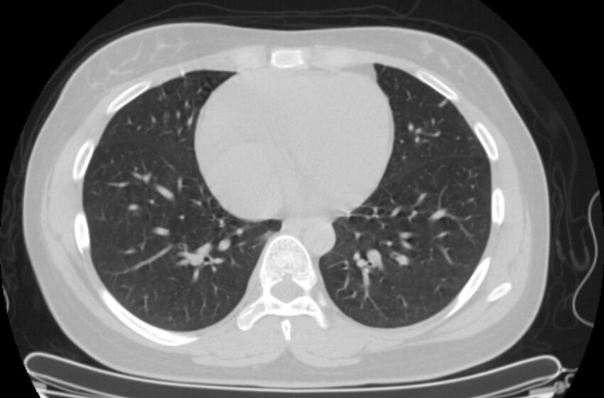 Cannonball metastases - uterine choriocarcinoma (Radiopaedia 70137-80173 Axial lung window 73).jpg