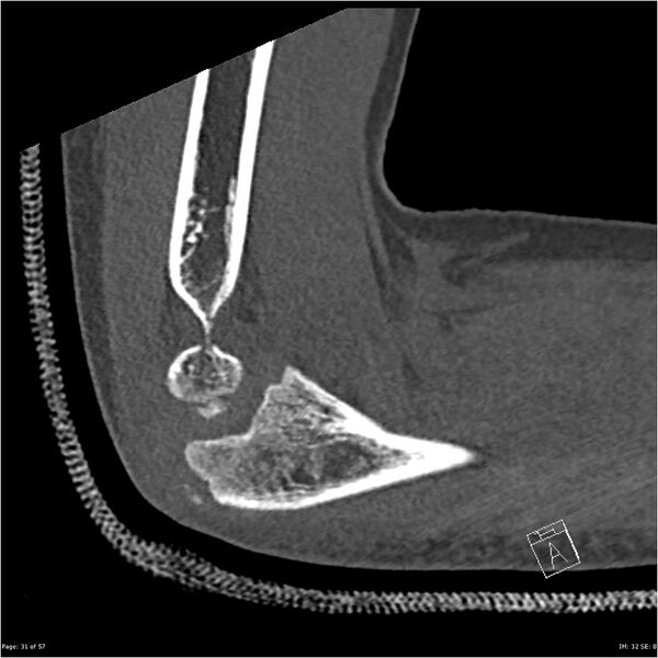 File:Capitellum fracture (Radiopaedia 23352-23426 Sagittal bone window 31).jpg