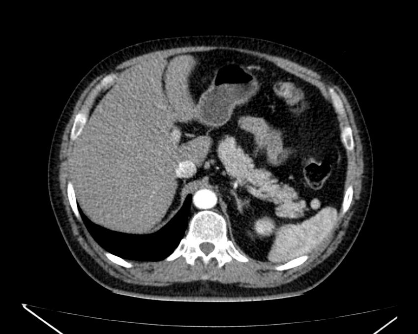 Carcinoid tumor with hepatic metastases (Radiopaedia 22651-22670 B 22).jpg