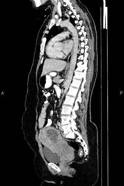 File:Carcinoma of uterine cervix (Radiopaedia 85861-101700 D 46).jpg